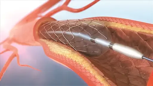 Đặt stent là phương pháp phổ biến trong điều trị bệnh mạch vành, suy tim.webp
